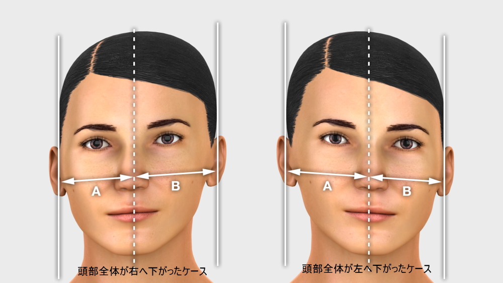 東京で小顔矯正を行うサロンが解説 顔の歪みを矯正する レミスティック東京の矯正はココが違う 痛くない小顔 矯正レミスティック 痛くなく 元に戻らないと評判の小顔矯正 小顔調整 エラ矯正 面長矯正 顔幅矯正 全国出張施術