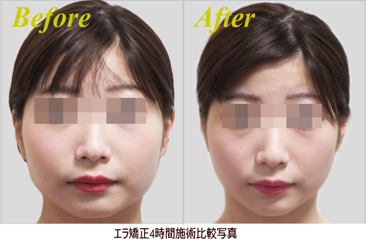 エラ張り矯正施術