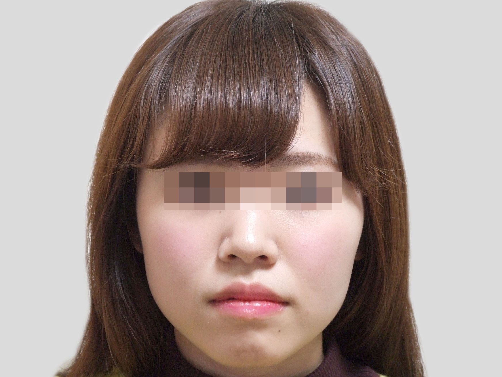 受け口矯正　ビフォア