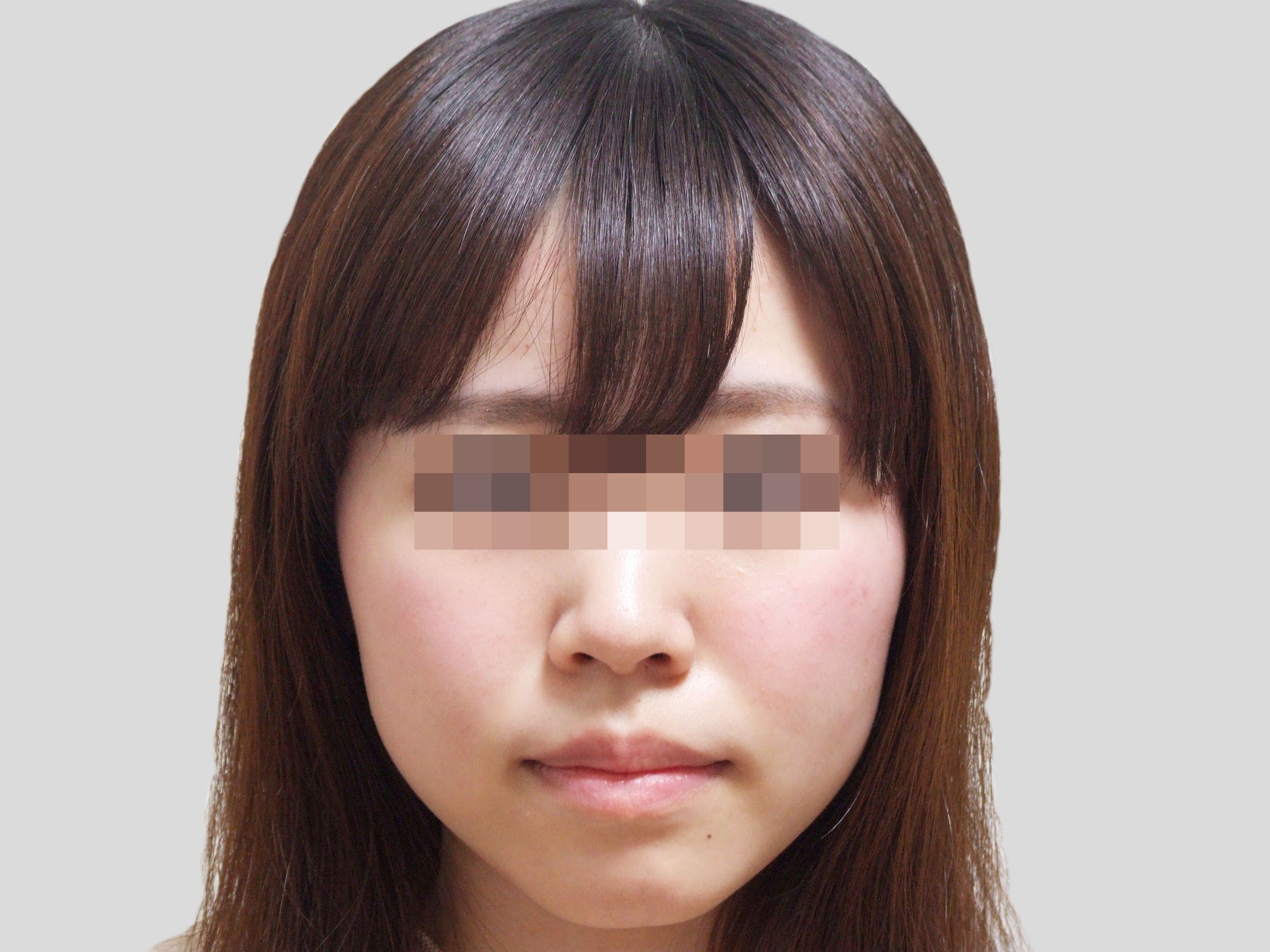 受け口矯正-アフター