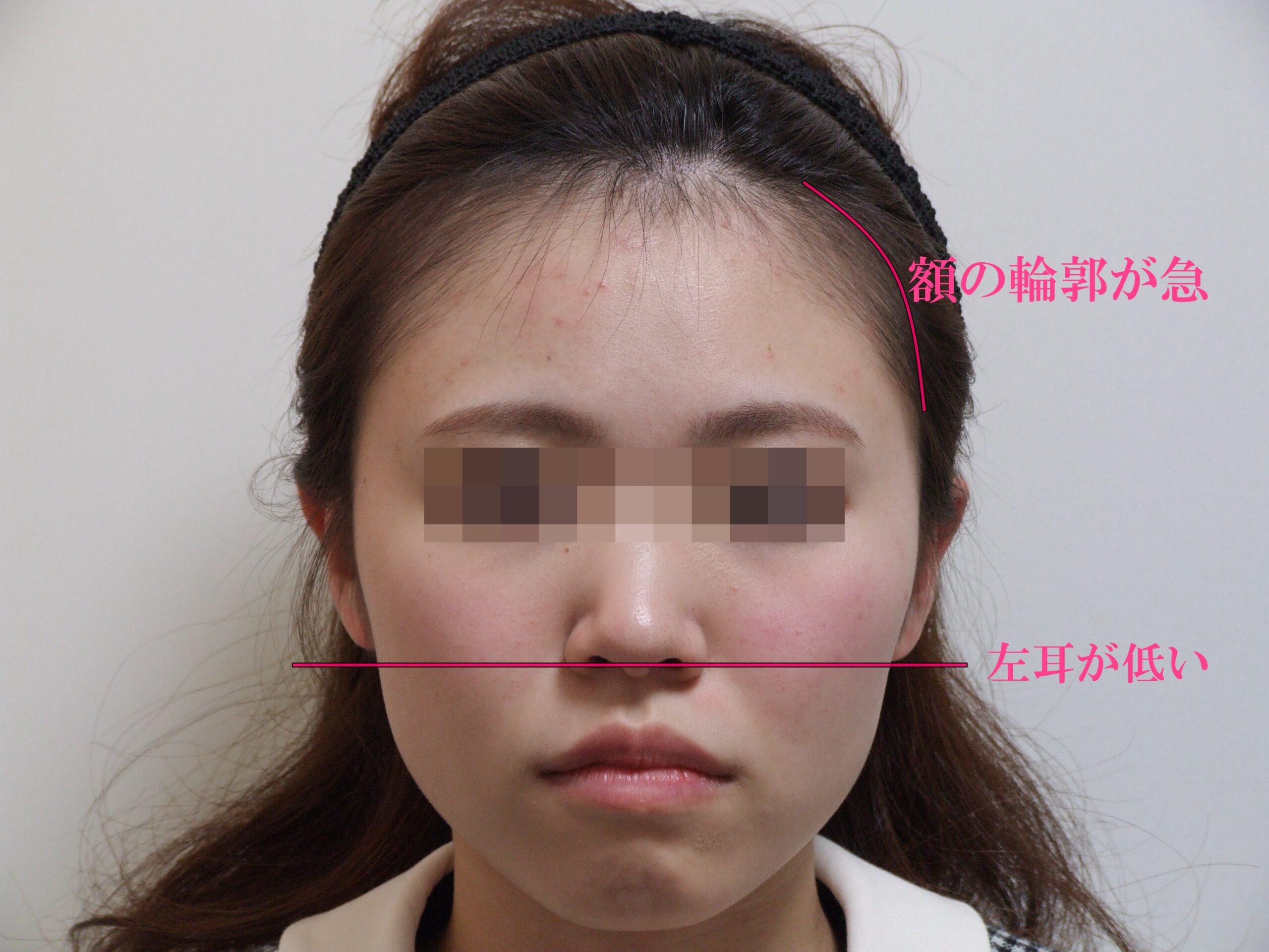 額の形と耳の高さ-ビフォア