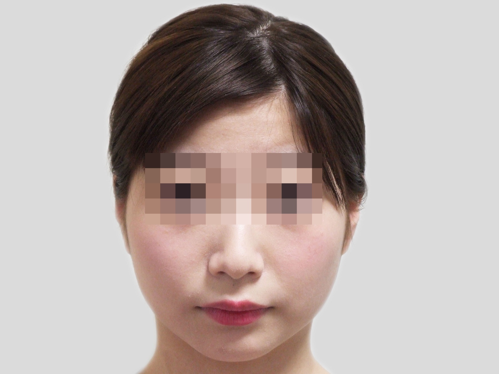 エラ矯正アフター