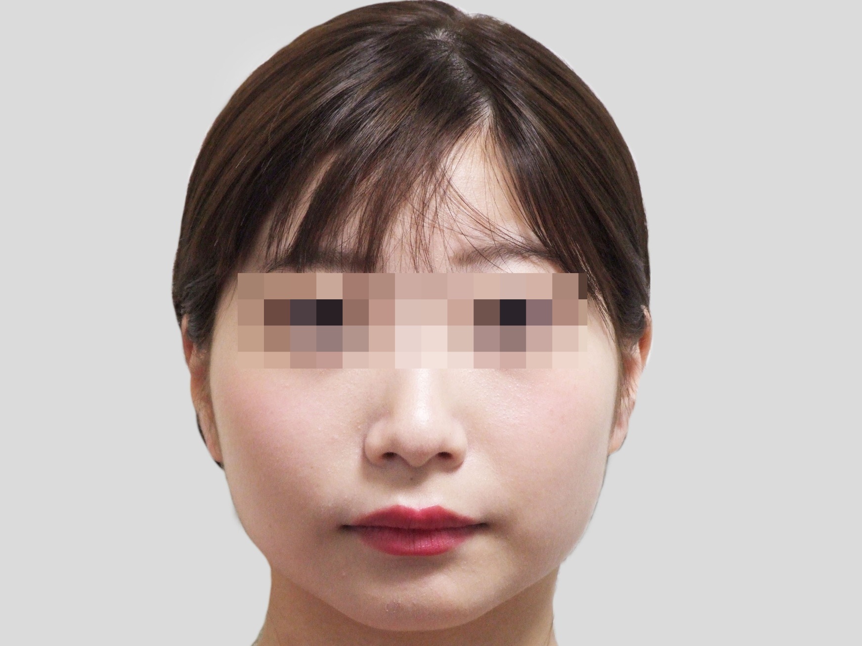 エラ矯正ビフォア